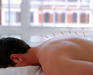 Acupuncture