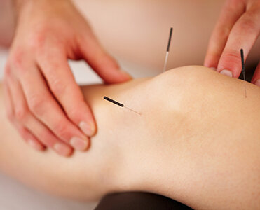 Acupuncture